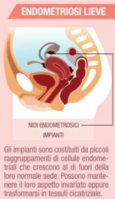 Infografica sull'endometriosi lieve