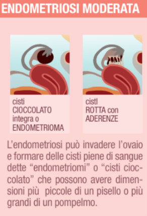 Infografica sull'endometriosi moderata