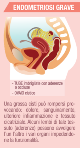 Infografica sull'endometriosi grave