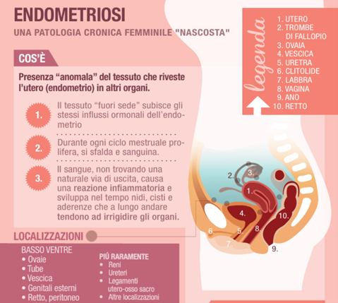 Infografica sull'endometriosi